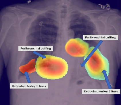 AI x-ray of kidneys